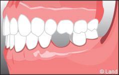 Pour remplacer les dents manquantes