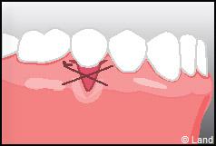 Chirurgie mucogingivale